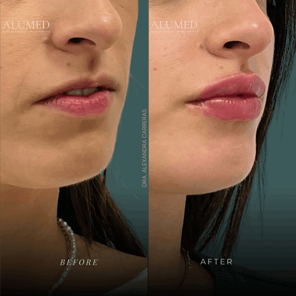 Aumento de labios natural con ácido hialurónico en ALUMED San Pedro Garza García