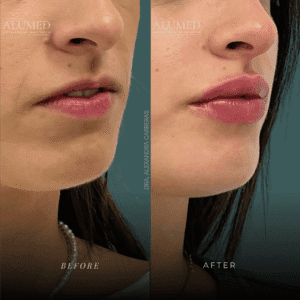 Aumento de labios antes y después caso 4 proyección y arco de cupido ALUMED San Pedro