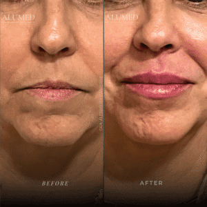 Aumento de labios antes y después caso 2 rejuvenecimiento labial paciente madura ALUMED