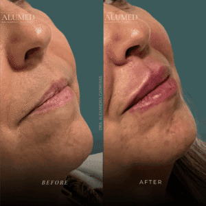 Aumento de labios antes y después caso 3 definición y plenitud labial ALUMED Monterrey