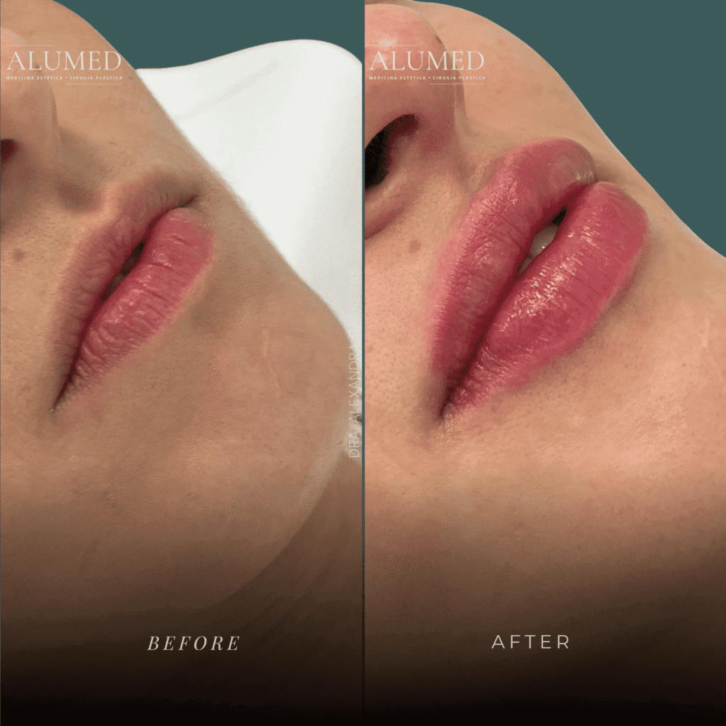 Aumento de labios antes y después caso 1 volumen y proyección natural ALUMED San Pedro