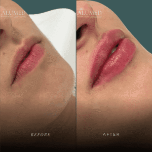 Aumento de labios antes y después caso 1 volumen y proyección natural ALUMED San Pedro