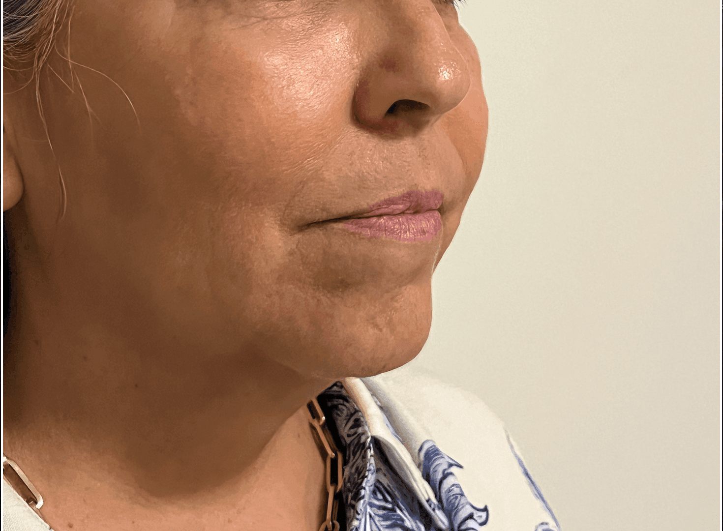 Labios sin volumen ni definición antes del diseño labial