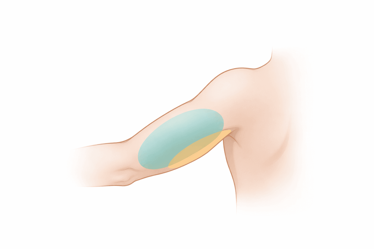 Zona de tratamiento: grasa tricipital y cara interna del brazo