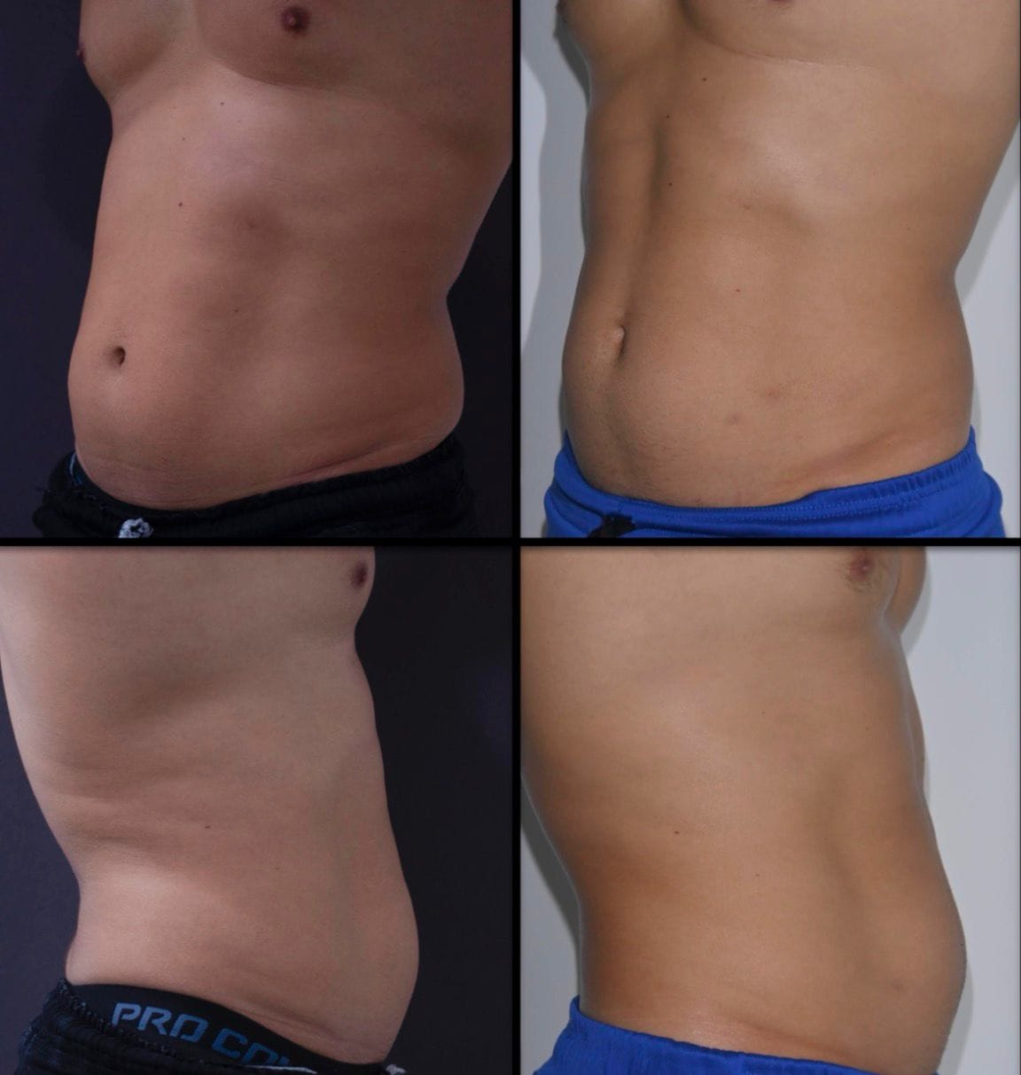 Endoláser antes y después en abdomen masculino vista frontal y lateral ALUMED