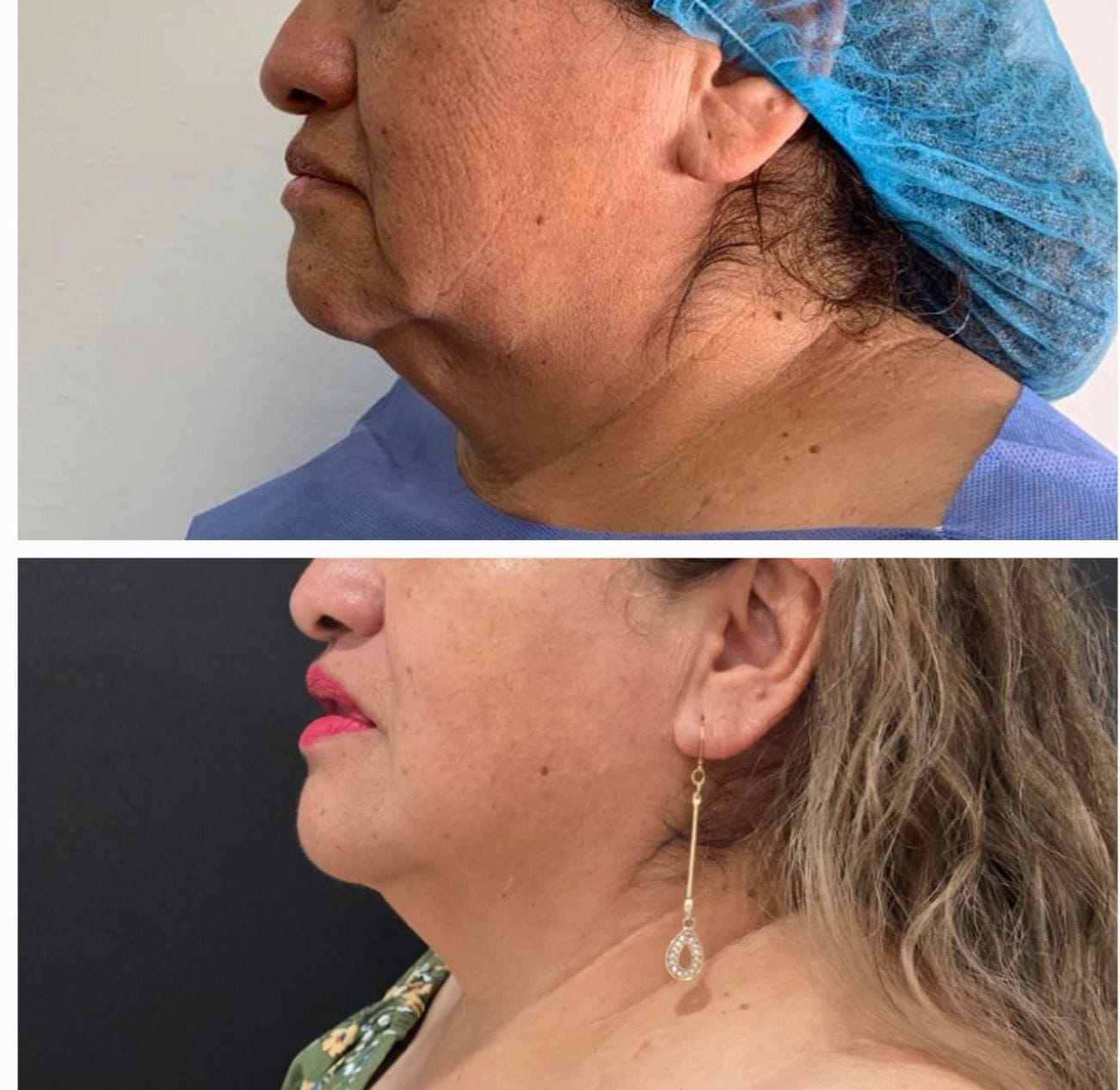Endoláser antes y después en papada pronunciada y cuello con laxitud ALUMED