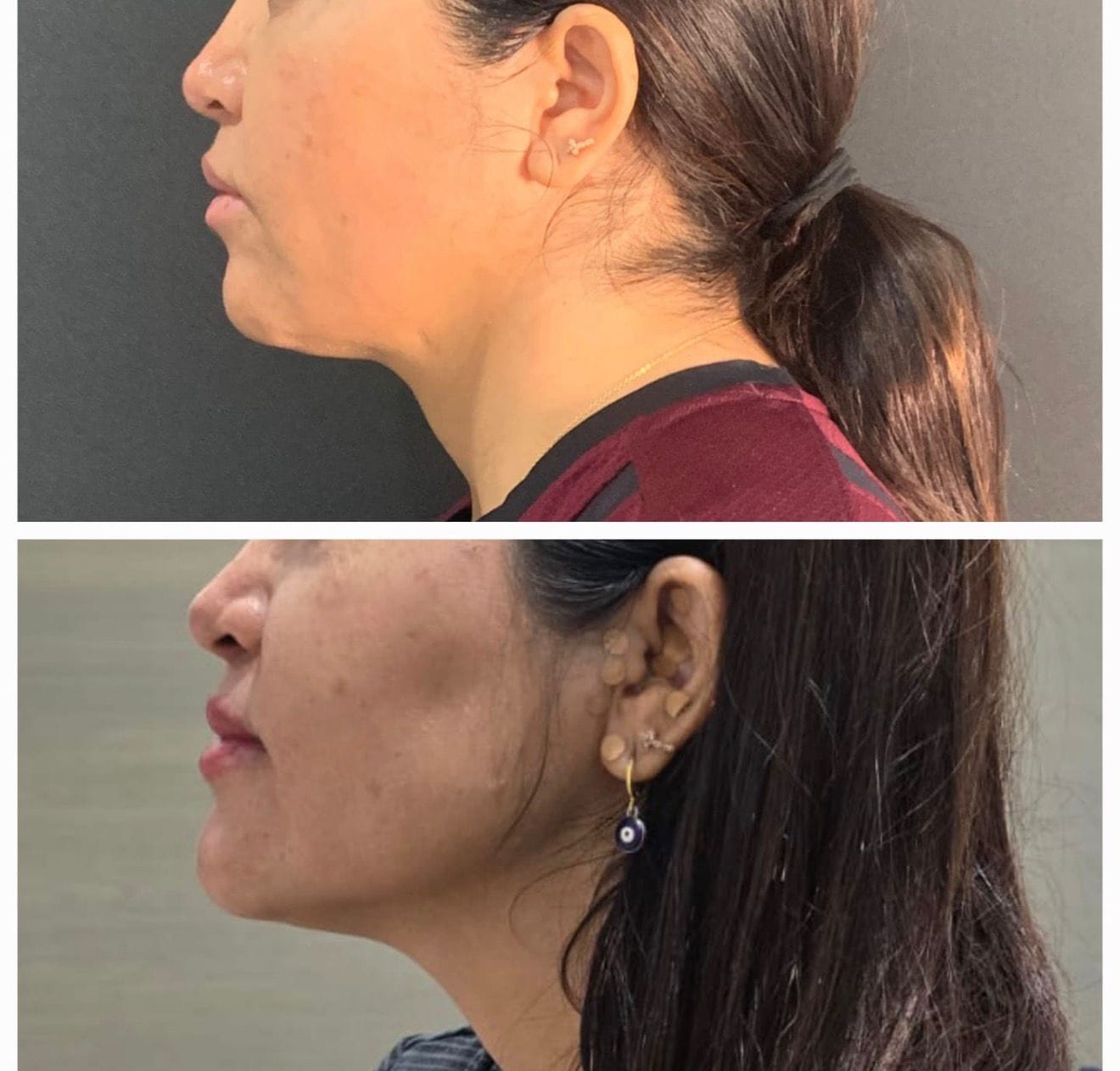 Endoláser antes y después para eliminar papada y definir perfil cervical ALUMED