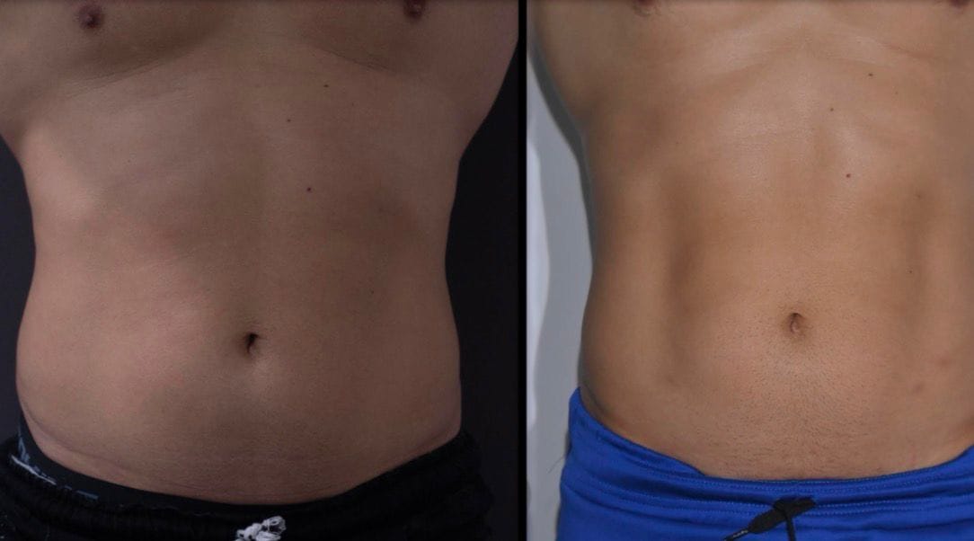 Endoláser antes y después en abdomen masculino vista frontal con lipólisis láser híbrido ALUMED