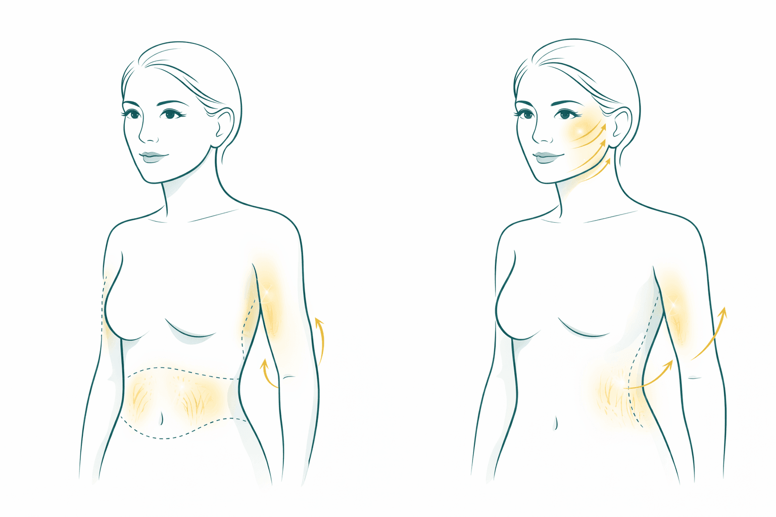 Zonas de tratamiento post-embarazo: abdomen, brazos, estrías, rostro
