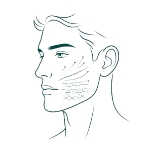 25. Endolifting High-Definition — Cuello y Mandíbula