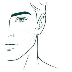 26. Peeling Anti-Acné — Hombres