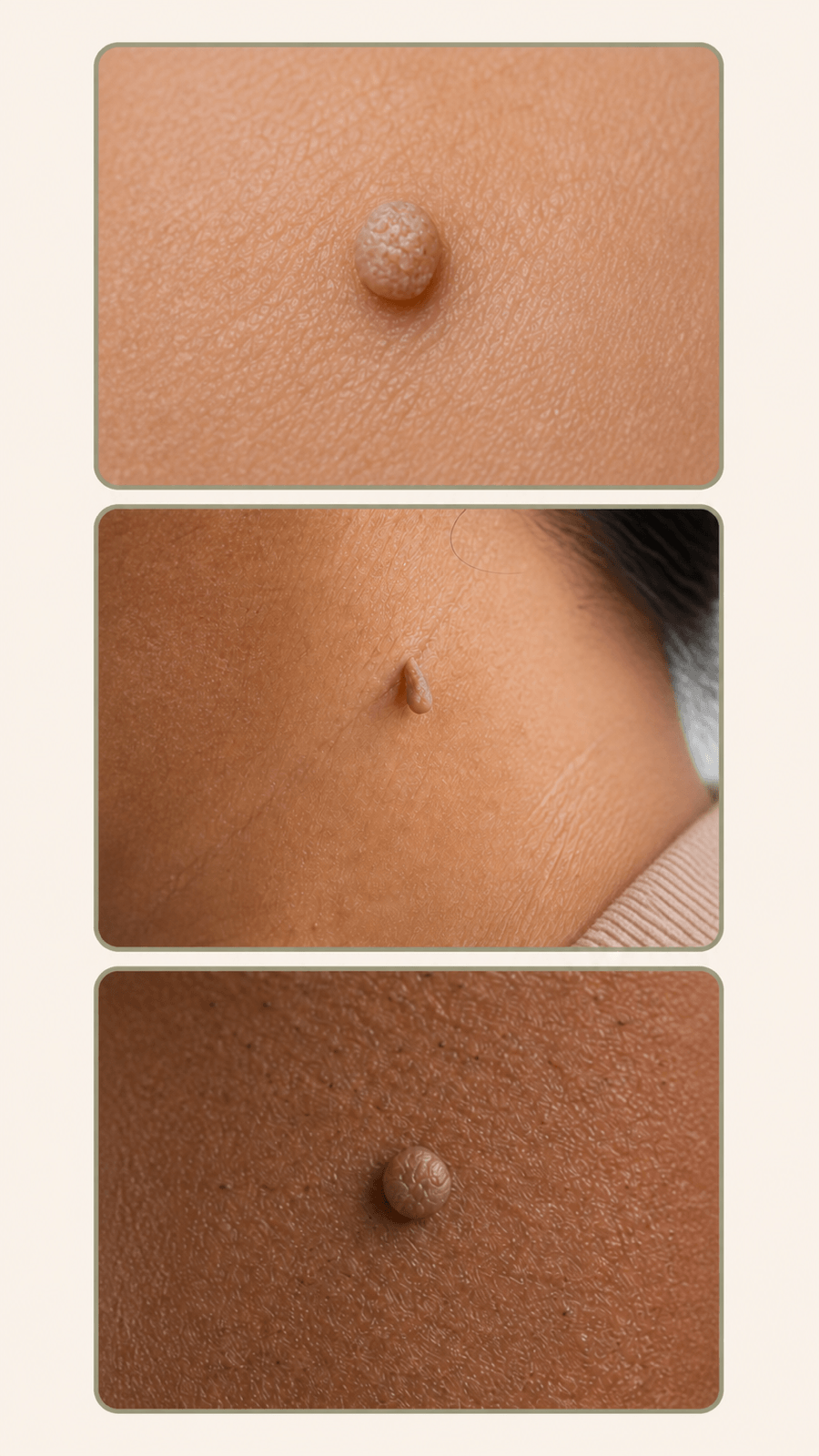 Diferencias orientativas entre verruga, mezquino, acrocordón y fibroma blando