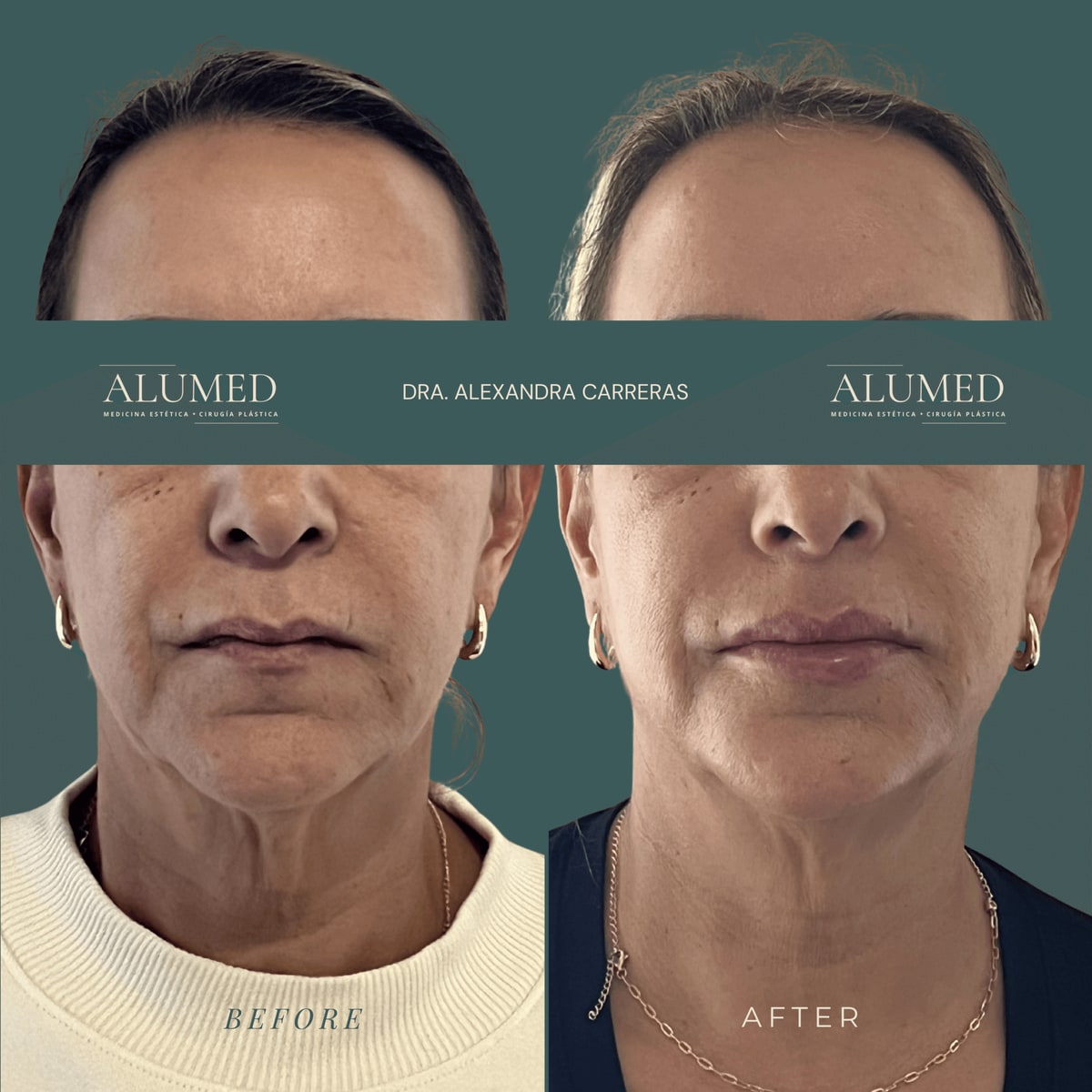 Antes y después de bioestimuladores de colágeno en ALUMED, San Pedro Garza García